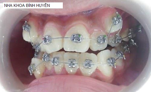 Hình ảnh NHA KHOA BÌNH HUYỀN